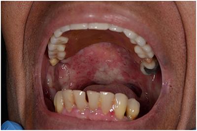 Case report: A case of anti-laminin 332 mucous membrane pemphigoid associated with severe pharyngolaryngeal involvement